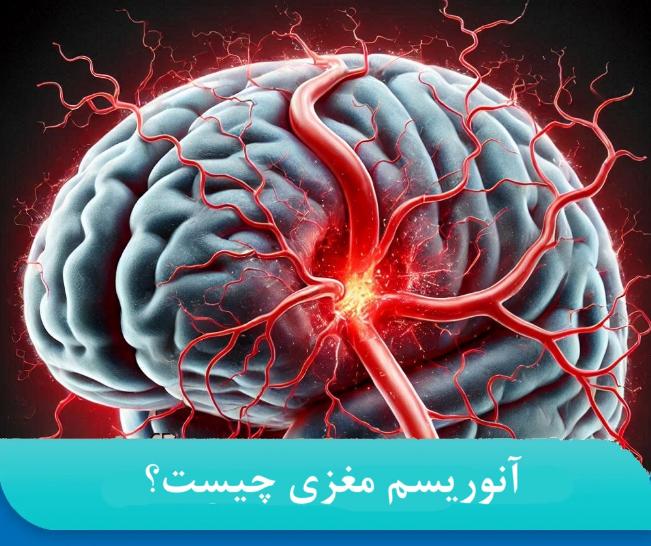 سبک زندگی سالم برای جلوگیری از آنوریسم مغزی چیست؟