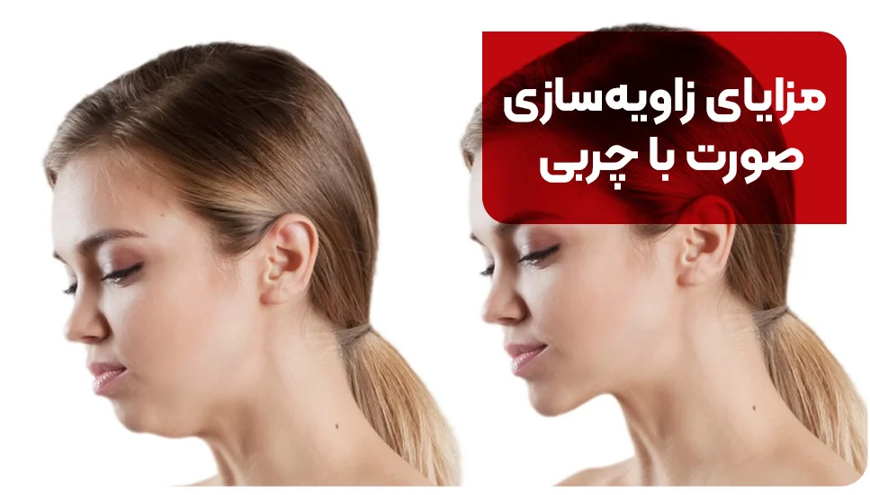 مزایای زاویه&zwnj;سازی صورت با چربی