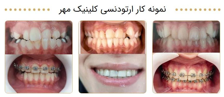 بهترین متخصص ارتودنسی کودکان در تهران در کلینیک دندانپزشکی مهر شریعتی