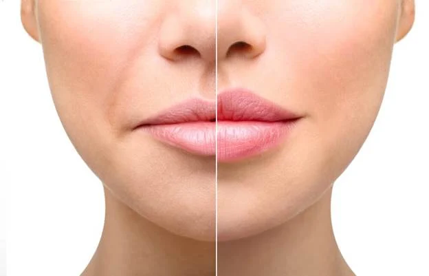 چند روز پس از تزریق ژل لب باید از کشیدن قلیون خودداری کرد؟